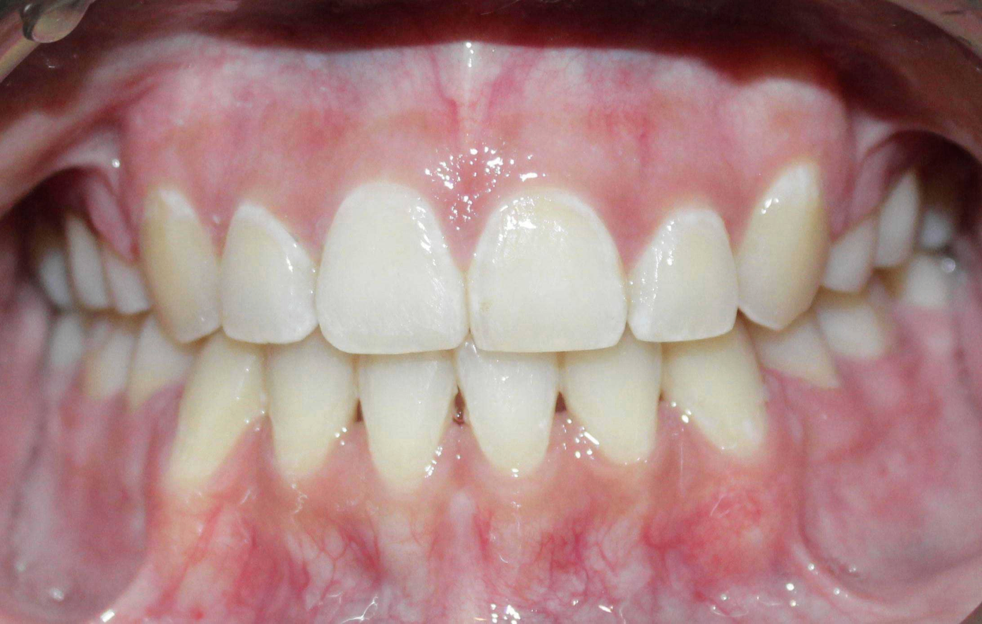 After treatment