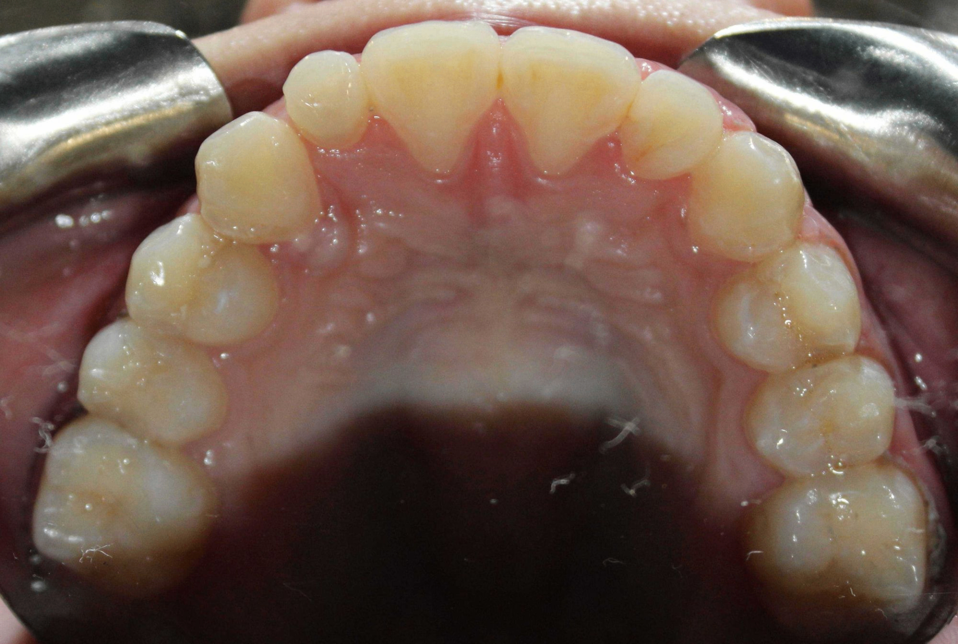After treatment