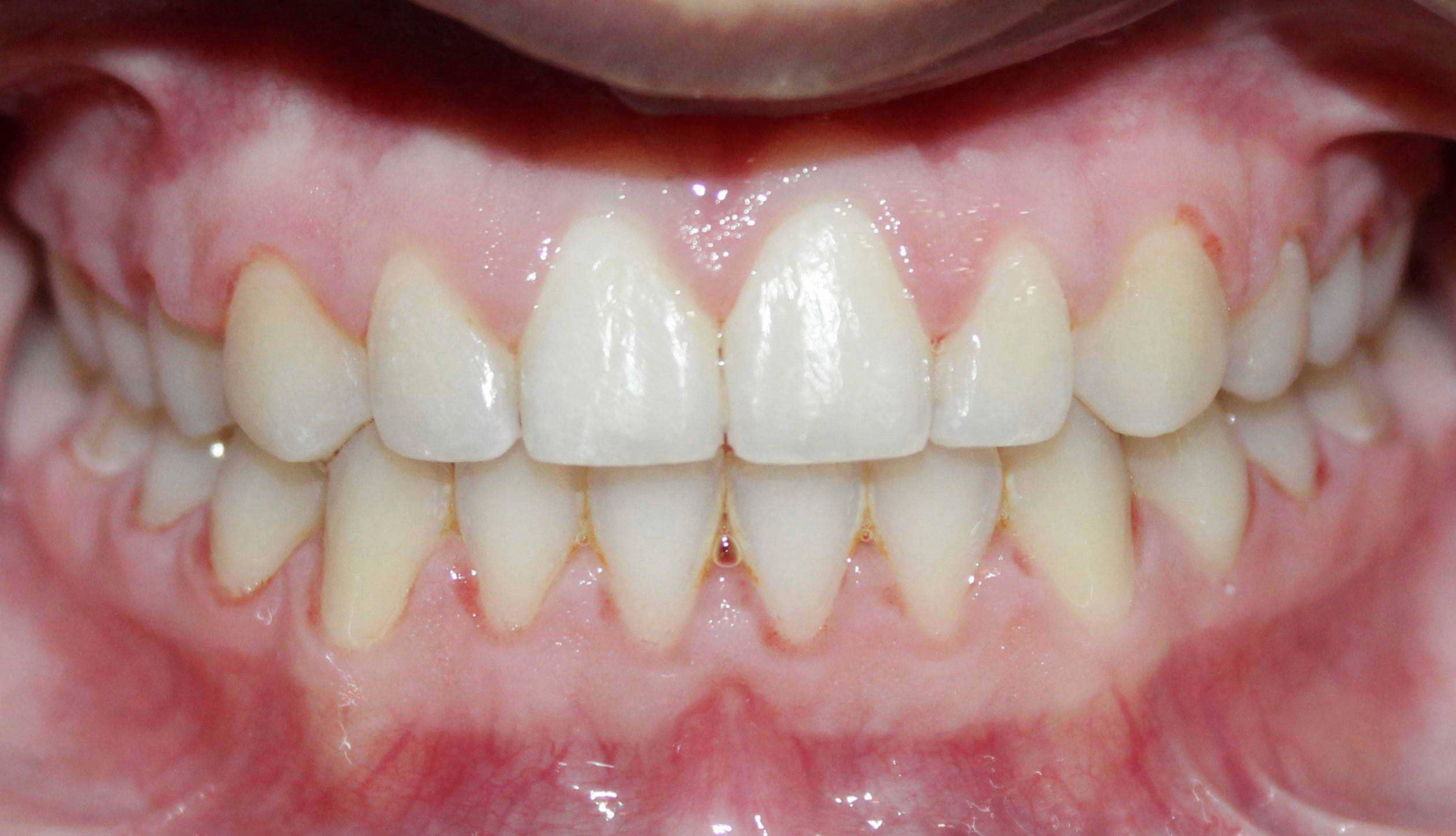 After treatment