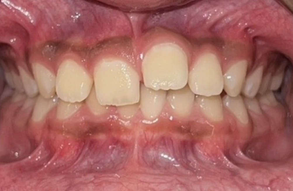 Before treatment