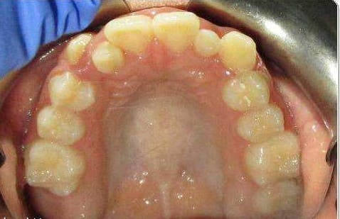 Before treatment