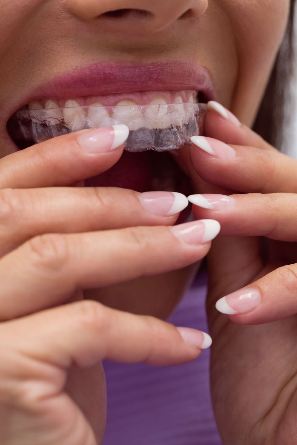 Patient placing a clear aligner